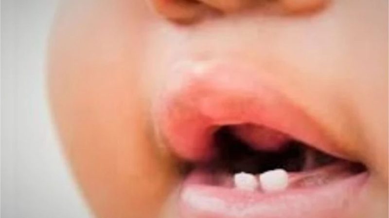 Teething doesn't cause cough, fever or diarrhea in babies, pediatricians warn