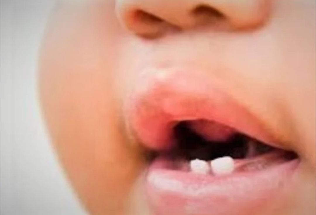 Teething doesn’t cause cough, fever or diarrhea in babies, pediatricians warn