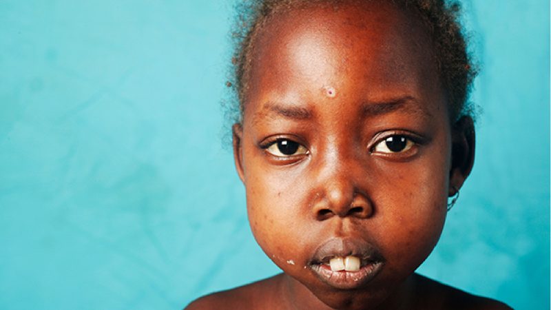 Foundation urges FG to subsidise sickle cell transplants