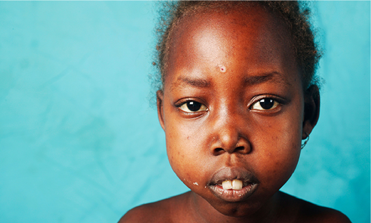 Foundation urges FG to subsidise sickle cell transplants