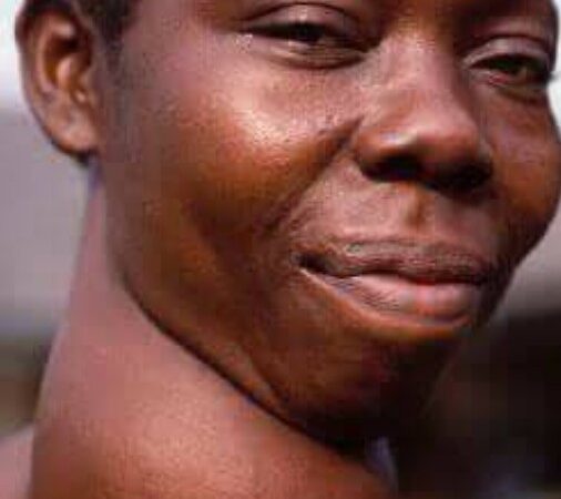 Thyroid disease: The silent health threat often overlooked in Nigeria